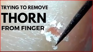 Trying to remove Thorn from finger [upl. by Ojytteb]