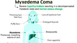 Myxedema comahypothyroidism [upl. by Woo]