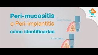 Perimucositis o periimplantitis ¿cómo identificarlas  Tu Salud Guía [upl. by Nagle]