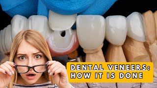 Dental Veneers Procedure Explained [upl. by Ahsinnod]