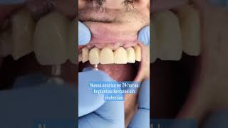 El ANTES y DESPUÉS de los implantes dentales Maravilloso cambio en menos de 24 horas [upl. by Neram]