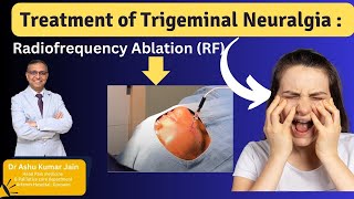 Relief from Trigeminal Neuralgia Effective Treatment with Radiofrequency Ablation [upl. by Wurster]