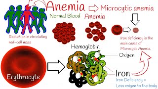 Iron deficiency anemia  Most Common anemia Microcytic anemia symptoms and treatment [upl. by Abbotson]