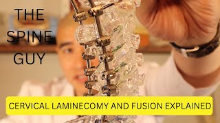 Cervical Laminectomy and Fusion Explained [upl. by Aikkin66]