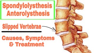 Spondylolisthesis or Anterolisthesis Causes symptoms and Treatment in UrduHindi [upl. by Llednik]