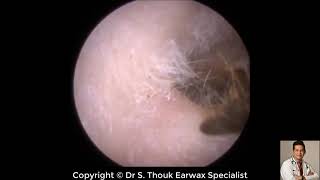 Top Biggest Ear Wax Removal 80  Ear wax Extraction  Dr S Thouk Earwax Specialist [upl. by Adachi883]