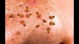 How To Removal Blackhead And How To Get Rid Of Blackhead Blackhead On Face 1 [upl. by Jaffe]