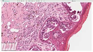 Ductal carcinoma in situ DCIS and Paget Disease  Histopathology [upl. by Noorah508]