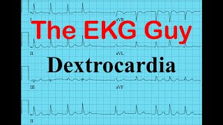 EKGECG  Dextrocardia  The EKG Guy  wwwEKGmd [upl. by Yecam439]