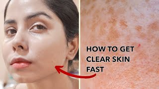 Dark Spots Treatment How to get rid of Dark Spots Pigmentation treatment  Dr Nirupama [upl. by Llenrep]