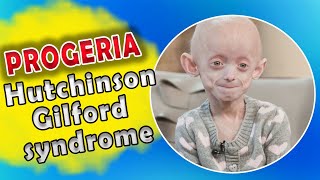 Genetic Disorder that causes you to grow Old Rapidly  Progeria  HutchinsonGilford syndrome [upl. by Hotze343]