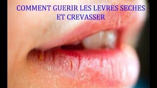 COMMENT SOIGNER LES LÈVRES SÈCHES ET CREVASSER [upl. by Natsyrk]