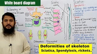 Deformities of skeleton part 02  Disc Slip  Spondylosis  Sciatica  Arthritis [upl. by Etterual417]