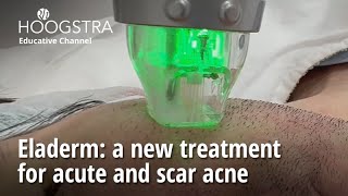 Eladerm a new treatment for acute and scar acne 24055 [upl. by Grubb]