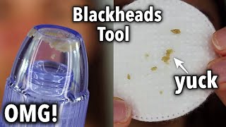 Comedo Suction Tool Review  DemoOMG  Blackheads Suction Tool  Does it work [upl. by Ileane262]