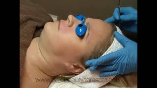 Dermaplane Facial Treatment With Minor Milia Skin Extractions Sarasota Florida [upl. by Emelyne]