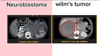 neuroblastoma Vs wilms tumor [upl. by Lais802]