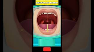 Removal of tonsils tonsilitis tonsils tonsilstones facts [upl. by Julissa]