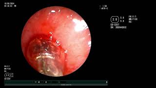 Emergent Central airway obstruction Subglottic stenosis  Dilatation and silicone stent placement [upl. by Tihom]