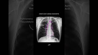 Heart Anatomy on Chest XRay  Shorts [upl. by Georgianne]