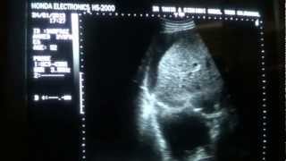 ASCITIC vs PLEURAL FLUID differentiation by ultrasound [upl. by Oliver685]