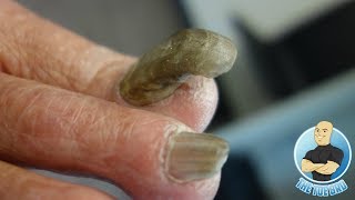 RAMS HORN 4 YEARS WITHOUT BEING CUT EXTREME TOENAIL CUTTING OF A THICK NAIL [upl. by Avery]