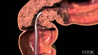 Evolution® Colonic ControlledRelease Stent  Uncovered Endoscopic Animation [upl. by Llehcim]