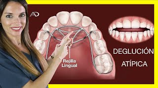 DEGLUCION ATIPICA ORTODONCIA CERRAR MORDIDA ABIERTA CON ORTODONCIA REJILLA LINGUAL Y BRACKETS [upl. by Rodavlas]