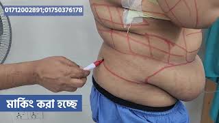 পেটের অতিরিক্ত চর্বি দূর করার উপায়। Tummy Tuck Surgery in Bangladesh [upl. by Kahaleel903]