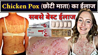 चिकन पॉक्स का बेस्ट ईलाज  Chicken pox treatment  छोटी माता का ईलाज  चेचक का ईलाज chickenpox [upl. by Gerri]