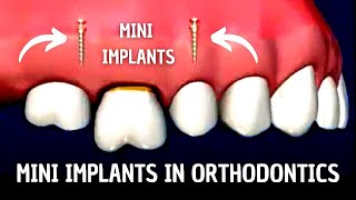 Mini Implants in Orthodontics [upl. by Zeb]