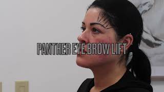 PDO Perfecto Threads  Eyebrow Lift  Eterna MD Medical Rejuvenation Center  Orlando FL [upl. by Clay]