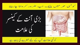 Large Intestine Colon Cancer 8 Symptoms And Sign In Urdu Badi Aant Ke Sartan Ki Alamat [upl. by Nevah]