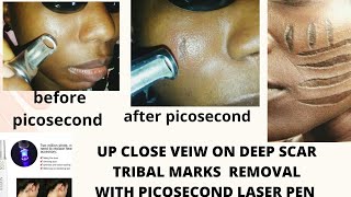 DEEP SCAR REMOVAL WITH PICOSECOND LASER PEN  VERY UPCLOSE VEIW [upl. by Nylahs]