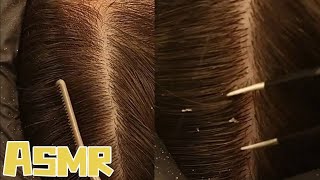 🎧ASMR｜ Real person decompression scalp care dandruff removal asmr [upl. by Bate]