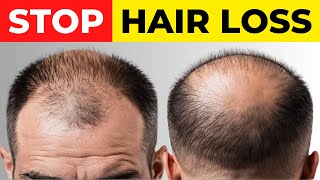 5 Powerful Vitamins That Prevent Hair Loss [upl. by Amalee]