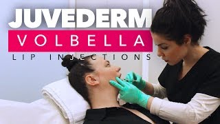 Juvederm Volbella Lip Injections  Juvederm Volbella Los Angeles CA [upl. by Landau]