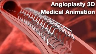 Angioplasty  Medical animation [upl. by Noynek165]