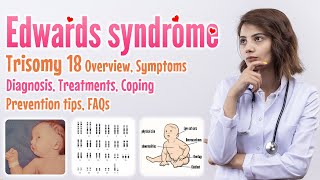 Edwards syndrome trisomy 18 causes symptoms diagnosis treatment screening prevention FAQ [upl. by Raine]