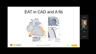 Pauley Heart Center Cardiology Grand Rounds  May 30 2024 [upl. by Otineb]