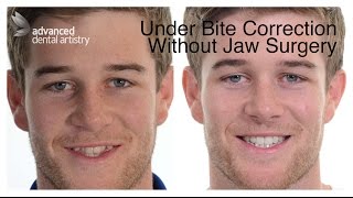 UnderBite Non Surgical Cosmetic Treatment  Shauns Transformation [upl. by Hope]