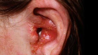 Acute Ear Inflammation  Otitis Externa  What is the Symptoms and treatment [upl. by Mackoff]