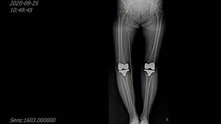 Periprosthetic fracture of right femur medial side after total knee arthroplasty [upl. by Lowney]