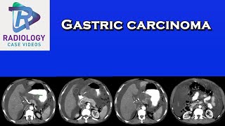 Gastric carcinoma [upl. by Maxantia]