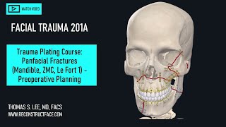 Panfacial Trauma Combined ZMC Le Fort 1 Mandible PS Angle Fx Surgical Planning 201A Didactic [upl. by Holihs]