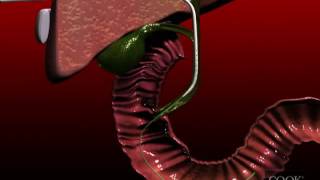 Biliary Drainage Catheter insertion animation [upl. by Eissirhc]