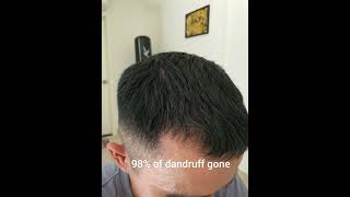 Day 30 Of Minoxidil Treatment  Without Finasteride [upl. by Enia]