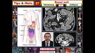 Tips amp Hints 27 Is is collapsed or thickened bowel wall [upl. by Sitarski355]