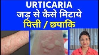 पित्ती  URTICARIA  जड़ से कैसे मिटाये  URTICARIA छपाकि homeopathic treatment [upl. by Roz]