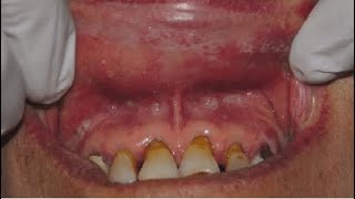 Association of Systemic Drugs in Oral Lichenoid Reaction [upl. by Ennad89]